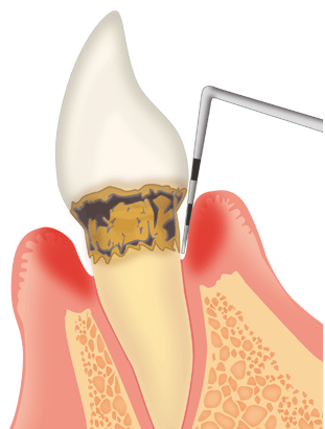 歯周病治療